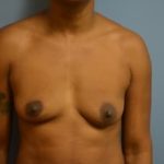 Breast Lift With Implants Before & After Patient #736