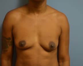 Breast Lift With Implants Before & After Patient #736