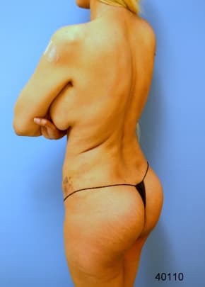 Buttocks Implants Before & After Patient #1134