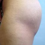 Buttocks Implants Before & After Patient #1133
