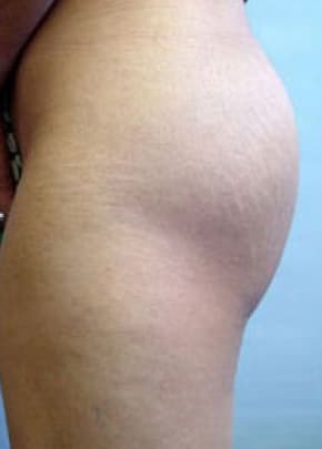 Buttocks Implants Before & After Patient #1133