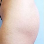 Buttocks Implants Before & After Patient #1133