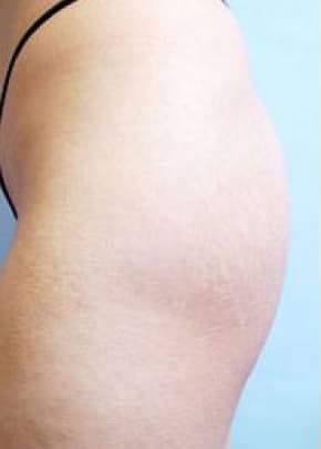 Buttocks Implants Before & After Patient #1133