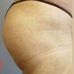 Buttocks Implants Before & After Patient #1132