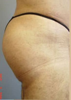 Buttocks Implants Before & After Patient #1132