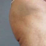 Buttocks Implants Before & After Patient #1132