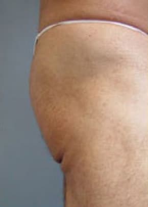 Buttocks Implants Before & After Patient #1132