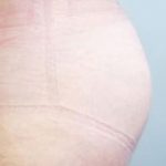 Buttocks Implants Before & After Patient #1131