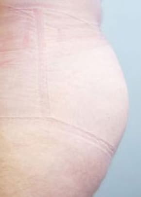 Buttocks Implants Before & After Patient #1131