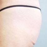 Buttocks Implants Before & After Patient #1131