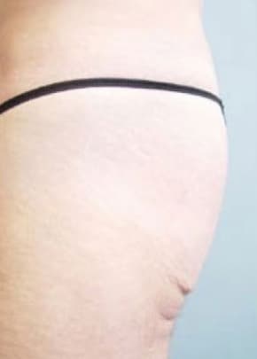 Buttocks Implants Before & After Patient #1131