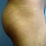 Buttocks Implants Before & After Patient #1130