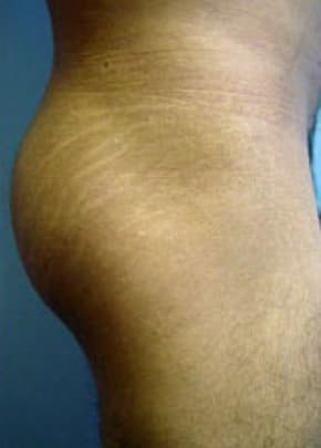 Buttocks Implants Before & After Patient #1130