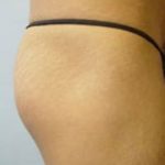 Buttocks Implants Before & After Patient #1130