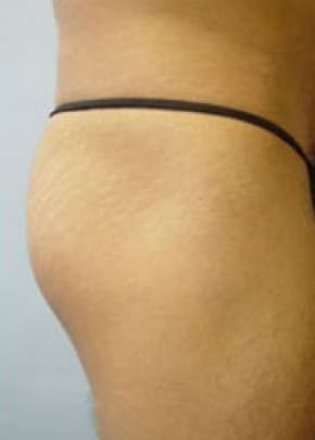 Buttocks Implants Before & After Patient #1130