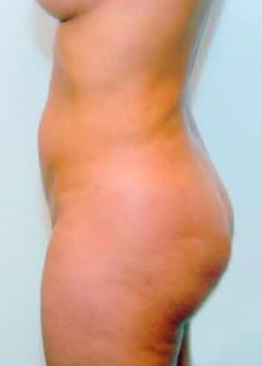 Buttocks Implants Before & After Patient #1129