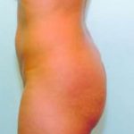Buttocks Implants Before & After Patient #1129