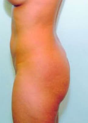 Buttocks Implants Before & After Patient #1129