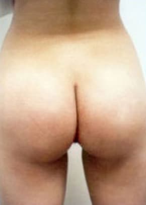 Buttocks Implants Before & After Patient #1128