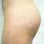 Buttocks Implants Before & After Patient #1127
