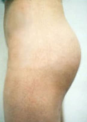 Buttocks Implants Before & After Patient #1127