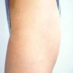 Buttocks Implants Before & After Patient #1127