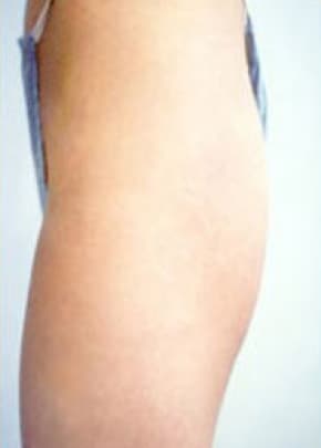 Buttocks Implants Before & After Patient #1127