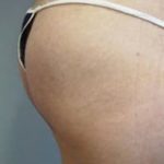 Buttocks Implants Before & After Patient #1126