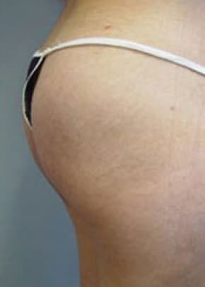 Buttocks Implants Before & After Patient #1126