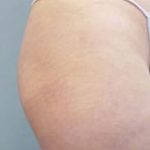 Buttocks Implants Before & After Patient #1126