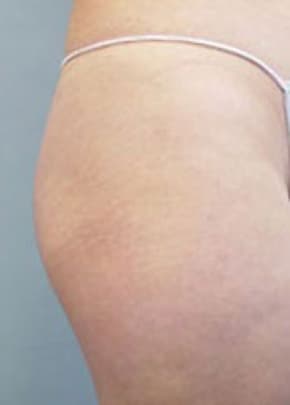 Buttocks Implants Before & After Patient #1126