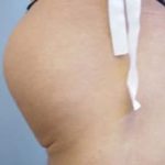 Buttocks Implants Before & After Patient #1125