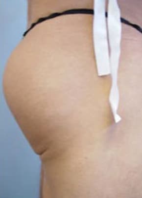 Buttocks Implants Before & After Patient #1125