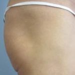 Buttocks Implants Before & After Patient #1125