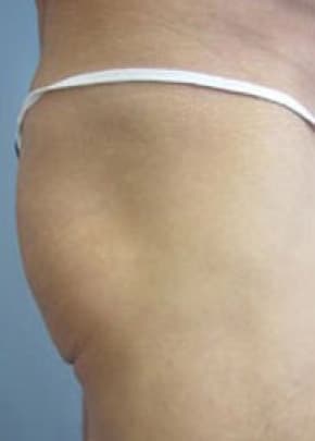 Buttocks Implants Before & After Patient #1125