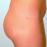 Buttocks Implants Before & After Patient #1110
