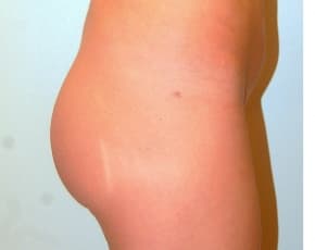 Buttocks Implants Before & After Patient #1110