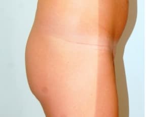 Buttocks Implants Before & After Patient #1110
