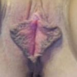 Female Enhancement Before & After Patient #1261