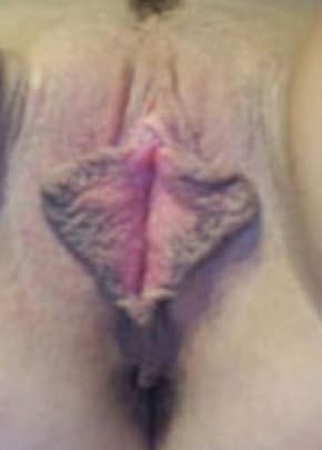 Female Enhancement Before & After Patient #1261