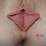 Female Enhancement Before & After Patient #1260