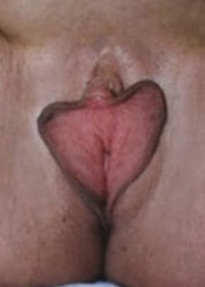 Female Enhancement Before & After Patient #1259
