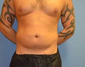 Abdominal Etching Before & After Patient #1245