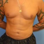Abdominal Etching Before & After Patient #1245