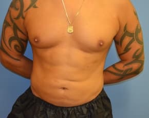 Abdominal Etching Before & After Patient #1245