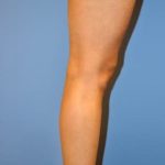 Implants For Bodybuilding Before & After Patient #1240