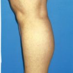 Implants For Bodybuilding Before & After Patient #1239