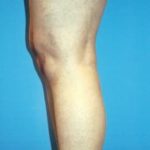 Implants For Bodybuilding Before & After Patient #1239