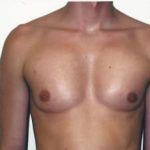 Implants For Bodybuilding Before & After Patient #1238