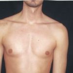 Implants For Bodybuilding Before & After Patient #1238